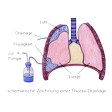 Illustration: Schematische Darstellung Thorax-Drainage: Flüssigkeit wird über Schlauch aus Lungenflügel in Behälter abgesaugt