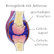 Illustration: Schnittzeichnung durch Kniegelenk: Durch Arthrose geschädigter Knochen, Gelenkschmiere, Gelenkkapsel