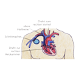 Illustration: Schematische Darstellung Herz mit Herzschrittmacher: Drähte des Schrittmachers verlaufen durch obere Hohlvene zu rechtem Vorhof und rechter Herzkammer