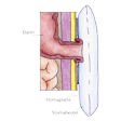 Illustration: Schnittzeichnung durch künstlichen Darmausgung: Darm, Stomaplatte, Stomabeutel