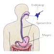 Illustration: Schematische Darstellung Magenspiegelung: Endoskop wird durch Mund und Speiseröhre in den Magen eingeführt