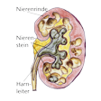 Illustration: Schnittzeichnung durch Niere mit Nierensteinen: Nierenrinde, Harnleiter, Nierenstein in Nierengängen und ableitendem Harnweg