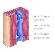 Illustration: Schnittzeichnung durch Vene: Kontraktion des Muskels neben Vene sorgt für Blutfluss, Klappe in Fließrichtung öffnet sich, geschlossene Klappe unterhalb des Muskels verhindert Rückfluss
