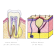 Illustration: Schnittzeichnungen durch Zahn und Gewebe: Innerer Abszess an der Zahnwurzel und äußerer Abszess in der Haut