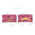 Illustration: Schnittzeichnungen durch Arterie: Sklerose im beginnenden und fortgeschrittenen Stadium