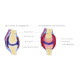 Illustration: Schnittzeichnungen durch Kniegelenk: Gesund und mit entzündeter, verdickter Gelenkkapsel durch Arthritis