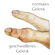 Illustration: Finger mit normalem und mit geschwollenem Gelenk
