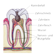 Illustration: Schnittzeichnung durch Zahn: Kariesbefall durch Zahnschmelz und Zahnbein bis zu Nerven- und Blutgefäßen