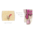 Illustration: Vorderansicht und Schnittzeichnung durch männliche Unterleibsgegend: Lage des Leistenbruchs neben den Geschlechtsorganen und Ausstülpung des Bauchfells und Darms durch die Lücke in der Bauchdecke