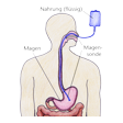Illustration: Schlauch vom Vorratsbehälter (Nahrung) über Nase und Speiseröhre in den Magen