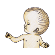 Illustration: Seitliche Ansicht eines Wasserkopfes bei einem Baby
