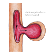 Illustration: Schnittzeichnung durch Arterie mit Aneurysma: Starke Ausbuchtung einer Arterienwand