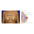 Illustration: Foto der weiblichen Brust mit Brustwarze, Warzenhof. Und schematische Darstellung einer Brust mit Muskel, Fettgewebe, Milchgang, Milchdrüse
