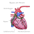 Illustration: Schematische Darstellung: Bypass am Herzen mit Aortenbogen, Herzkranzarterien, Gefäßverschluss