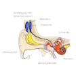 Illustration: Schematische Darstellung des Cochlear-Implantats im Ohr: Ohrmuschel, Sendespule mit Sprachprozessor, Mikrofon, Implantat, Schnecke, Hörnerv, aktive Elektrode