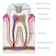 Illustration: Schnittzeichnung durch Zahn: Füllung in Zahnschmelz und Zahnbein