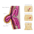 Illustration: Verschiedene Arten von Hernien: Leistenbruch, Schenkelbruch, Nabelbruch. Und Schnittzeichnung durch Hernie: Ausstülpung von Bauchfell und Darm durch Öffnung in Bauchdecke