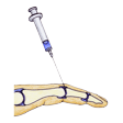 Illustration: Schematische Darstellung: Intraartikuläre Injektion in ein Fingermittelgelenk
