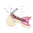 Illustration: Schematische Darstellung Intubation: Tubus mit Ballon an Spitze, Kontrollballon und Laryngoskop ist an Zunge und Kehldeckel vorbei in Luftröhre eingeführt