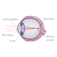 Illustration: Schnittzeichnung durch Auge: Lichtstrahlen fallen durch Hornhaut und Linse, Brennpunkt liegt vor Netzhaut