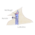 Illustration: Schematische Darstellung Luftröhrenschnitt: Kehlkopf, Luftröhre, Kanüle ist von außen auf Halshöhe unterhalb des Kehlkopfes in die Luftröhre gelegt