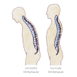 Illustration: Schnittzeichnungen durch menschlichen Körper: Normale und versteifte Wirbelsäule (nach vorne gebeugte Haltung)