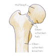 Illustration: Schematische Darstellung Oberschenkelhalsbruch: Oberschenkelknochen, Oberschenkelhals mit Fraktur, Hüftkopf