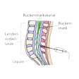 Illustration: Schematische Darstellung Periduralanästhesie: Auf Höhe der Lendenwirbelsäule (zwischen drittem und viertem Lendenwirbel) wird in den Zwischenraum zwischen Rückenmarkskanal und Wirbeln injiziert