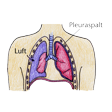 Illustration: Schematische Darstellung Pneumothorax: Luft gelangt von außen in Pleuraspalt