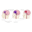 Illustration: Schematische Darstellungen verschiedener Formen von Schlaganfall: Durchblutungsstörung durch Thrombus, Durchblutungsstörung durch angeschwemmten Embolus, Blutung durch Verletzung