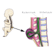 Illustration: Schnittzeichnung durch Wirbelsäule bei Spina Bifida: Rückenmark wölbt sich durch Lendenwirbel hindurch aus, bildet eine Wölbung am Rücken des Kindes