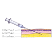 Illustration: Schematische Darstellung: Subkutane Injektion durch Ober- und Lederhaut in Unterhaut