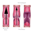 Illustration: Schnittzeichnungen durch gesunde Vene, Vene mit beginnender und Vene mit fortgeschrittener Thrombose: Durch das Blutgerinnsel wird der Blutfluss schwächer, bis das Gefäß gänzlich verstopft ist