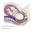 Illustration: Schnittzeichnung durch Unterleib einer liegenden Schwangeren: Hohlvene wird durch Gebärmutter komprimiert