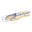 Illustration: Verweilkanüle am Handrücken eines Patienten