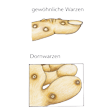 Illustration: Gewöhnliche Warzen am Finger und Dornwarzen an Fußsohle und Unterseite der Zehen