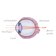 Illustration: Schnittzeichnung durch Auge: Lichtstrahlen fallen durch Hornhaut und Linse, Brennpunkt liegt hinter Netzhaut
