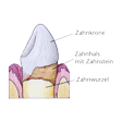 Illustration: Schematische Darstellung Zahn mit Zahnstein: Zahnkrone, Zahnhals mit Zahnstein, Zahnwurzel